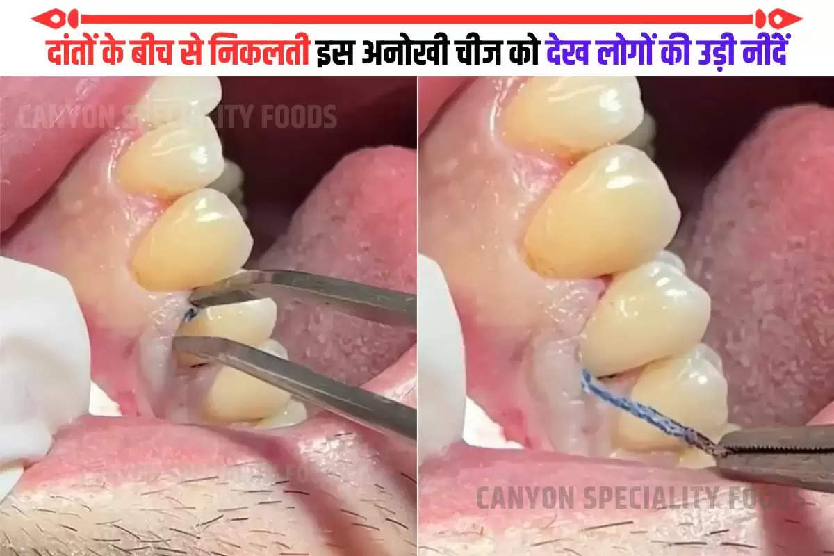 dental packing cord video