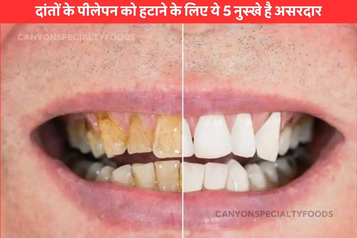 Home remedy to Whiten teeth 